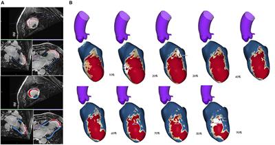 Cardiac Magnetic Resonance for Ventricular Tachycardia Ablation and Risk Stratification